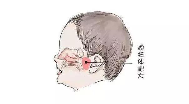 銘仁耳鼻喉專家分享：兒童腺樣體肥大怎么治療比較好？(圖1)