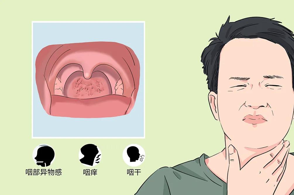 專家分享：咽炎難說“再見” 要對癥治療(圖2)