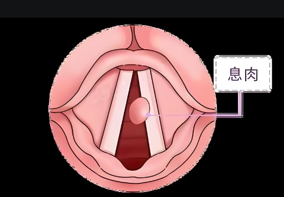 聲音嘶啞、嗓子難受，聲帶息肉不可小覷(圖1)